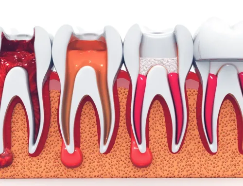 A Root Cause Medicine Approach to Root Canals